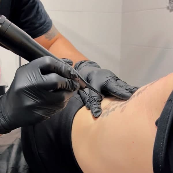 Sesión de láser para eliminación de tatuaje en brazo
