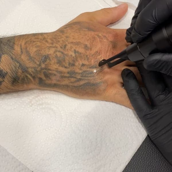 Tratamiento de aclarado de tatuaje con láser